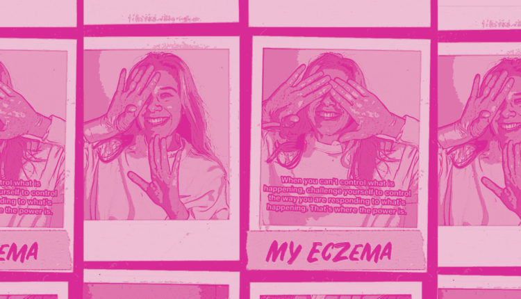 Want To Know Why I Show Off My Eczema So Much?